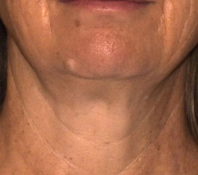 Sofwave before and after, published example, Square Mile Clinic, City of London After 12 weeks Sofwave neck procedure by Suzanne Kilmer, published example, Sofwave at Square Mile Clinic